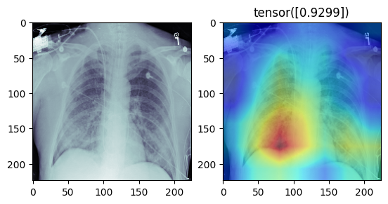 Pneumonia Detection